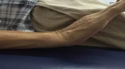 【康复指导】脑出血偏瘫患者正确的行走练习