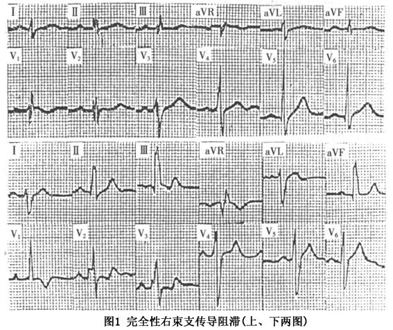 窦性心律 完全性右束支传导阻滞_窦性心律 ,完全性右束支传导阻滞 ,心